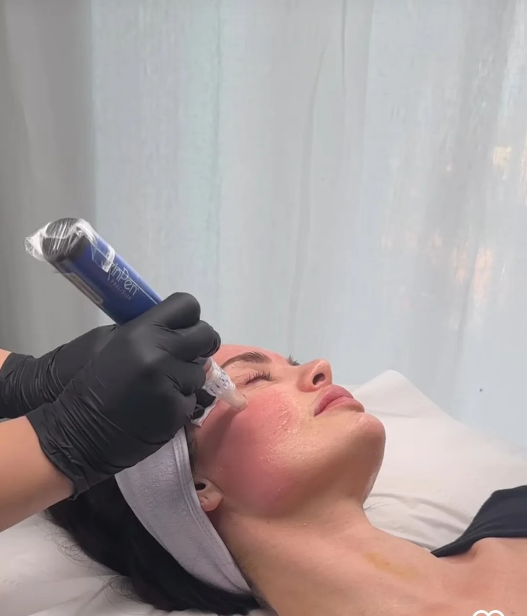Microneedling med SkinPen